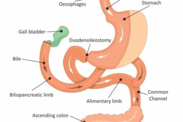 biliopancreatic_diversion_mediterra_assistance