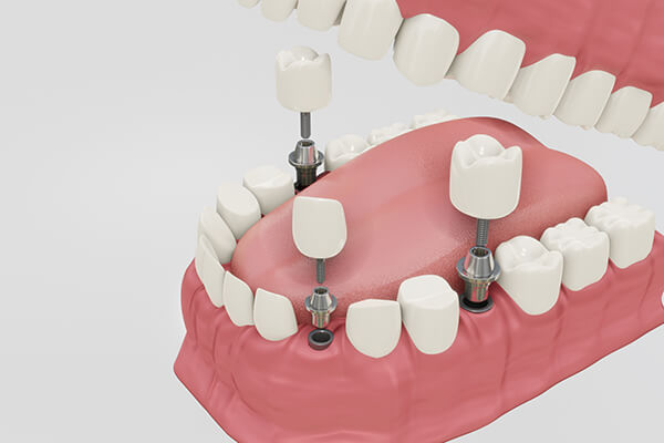 dental_crowns_mediterra_assistance