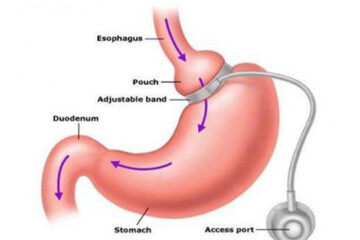 gastric_banding_mediterra_assistance