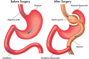 gastric_bypass__mediterra_assistance