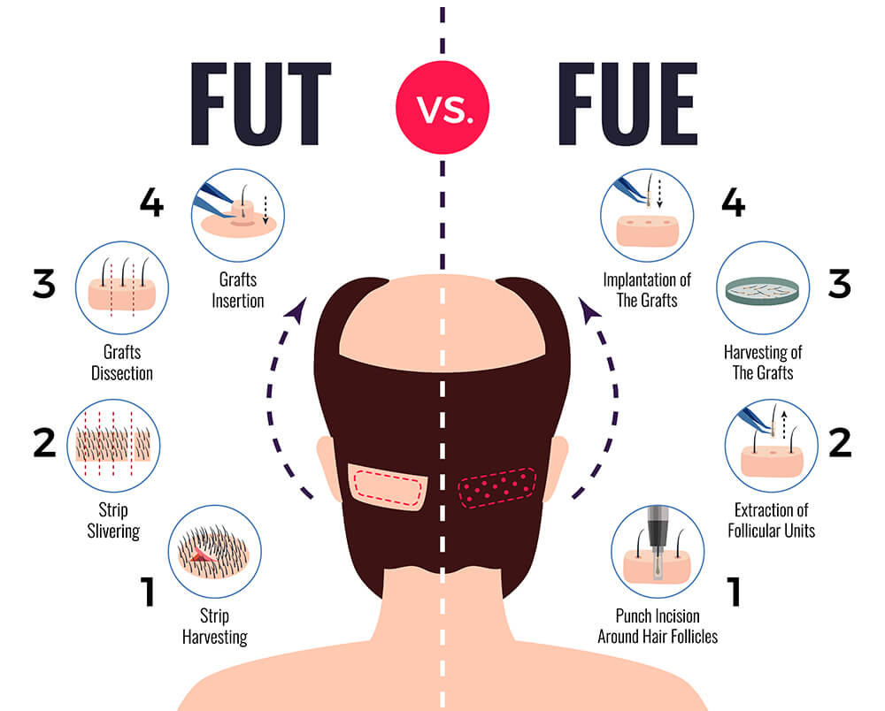 hair_loss_treatment_mediterra_assistance